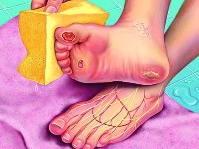 Cách chăm sóc bàn chân với người tiểu đường